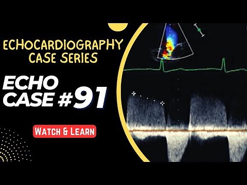 ECHO CASE 91 | Echocardiography for Beginners | Echocardiogram Interpretation | 2D Echo Basics