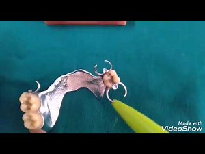 Parts Of Removable Partial Denture