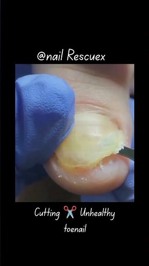 ingrown toenail removal.#satisfying #nailcare #nails #nailtreatment #foot #extraction #footcare