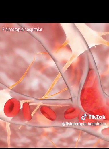 O AVC (Acidente Vascular Cerebral) pode ser classificado em dois tipos principais: isquêmico e hemorrágico, cada um com características distintas: 1. **AVC Isquêmico:** É o tipo mais comum de AVC, representando cerca de 85% dos casos. Ele ocorre quando um vaso sanguíneo que irriga o cérebro é bloqueado por um coágulo de sangue (trombo) ou por um êmbolo (um coágulo que se formou em outra parte do corpo e se deslocou até o cérebro). Esse bloqueio impede a chegada de sangue e oxigênio a uma parte d