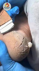 819K views · 6.4K reactions | How to Care for Your Nails and Keep Your Feet Comfortable #ingrownnail #ingrowntoenail #nails | Evgeniy | Facebook