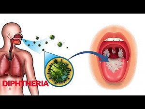 Watch how to sign 'diphtheria' in American Sign Language.