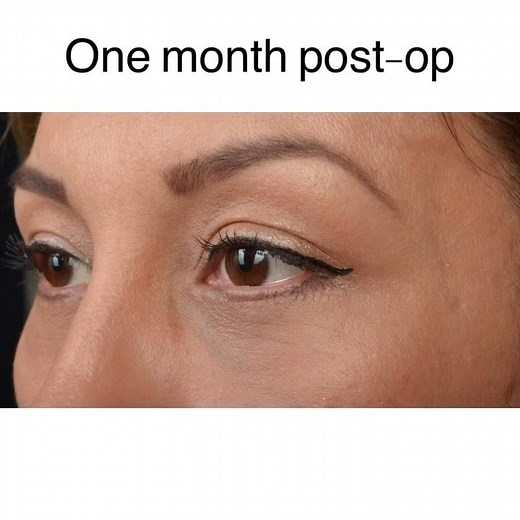 Lower Eyelid Blepharoplasty with Fat Repositioning, CO2 Laser