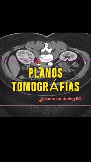 🔹 Los Planos anatómicos se refieren a las divisiones teóricas del cuerpo utilizadas en anatomía para describir estructuras y relaciones espaciales. Los principales son: Plano axial (transversal) → Divide el cuerpo en superior e inferior. Plano coronal (frontal) → Divide el cuerpo en anterior y posterior. Plano sagital → Divide el cuerpo en derecha e izquierda. 🔹 Cortes tomográficos se refieren a las imágenes adquiridas por el escáner en un estudio de tomografía. Estos cortes siguen los planos 