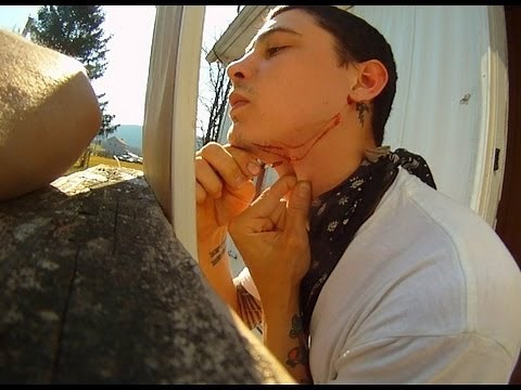 Big Splinter Removal