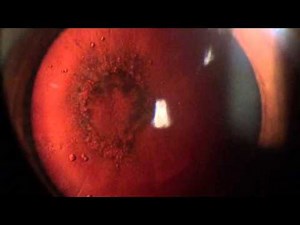Cataract (posterior sub capsular). Catarata subcapsular posterior