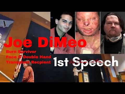 Burn Survivor, Face & Hand Transplant Recipient Joe DiMeo’s Powerful First Public Speech