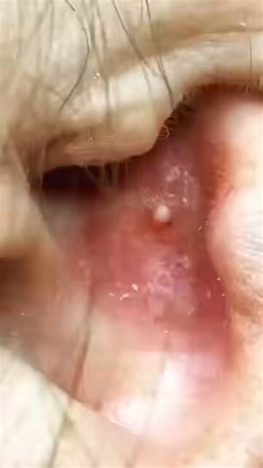 For more videos : https://t.co/mBbtBHJWLk Blackhead removal / Pimple popping / Pimple Patch / Comedon #pimpleremover #pimple #pimplepopping #popping #blackheadremoval blackhead acne cyst komedon zit skincare pimplepopper zits pimplepatch pimplepatcher comedon