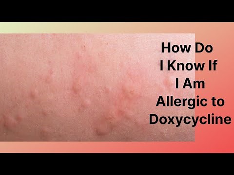 How Do I Know If I Am Allergic to Doxycycline