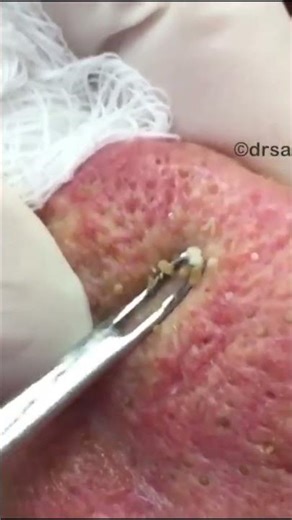 Squeezing blackheads from an elderly person's nose #satisfying