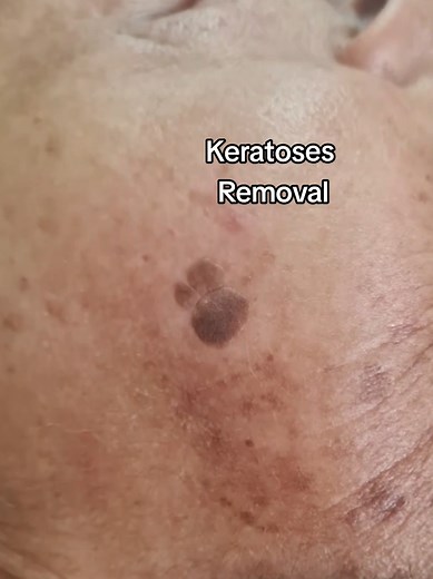Keratoses are benign skin growths caused by an overproduction of keratin, often linked to sun exposure, aging, or genetic factors. Cautery removal is a precise medical technique that uses controlled heat to safely remove the lesion while minimizing damage to the surrounding skin. A quick and effective treatment that safely removes unwanted keratoses, leaving your skin smoother, clearer, and more even in appearance. #keratosis #cautery #skincare #precison #glowup 📍Umhlanga ☎️ 064 9407128