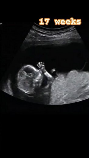 Ultrasound Scan Of 17 Week Old Fetus #shorts #babygirl #ultrasound