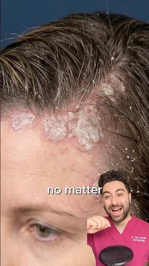 How to treat a SCALY SCALP