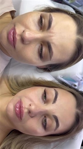 Botulinum toxin therapy for the forehead is a procedure in which botulinum toxin (most commonly Botox) injections are used to reduce the appearance of wrinkles and lines on the forehead. This area is prone to the formation of expression lines due to frequent muscle movements, such as raising the eyebrows or making a surprised expression. Procedure goals: 1. Injections help relax the muscles, which smooths out horizontal lines that can appear on the forehead. 2. Correction of vertical lines. 3. R