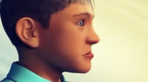 Crossbite ( Underbite) Treatment by Bone Anchored Maxillary Protraction - Orthodontic Treatment | Dr.Sreenath S