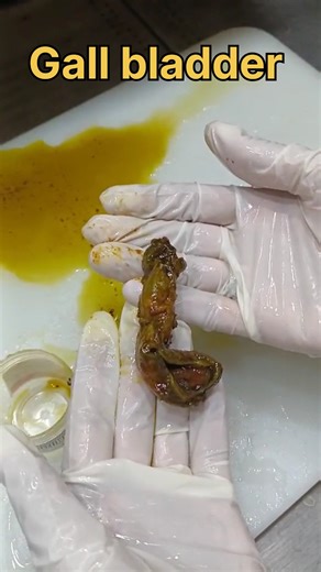 Gall bladder specimen with stones 🤯| #histopathology #histomuseum #gallbladder #gallbladderdisease