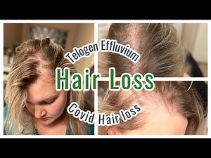 MY HAIR LOSS EXPERIENCE | TELOGEN EFFLUVIUM
