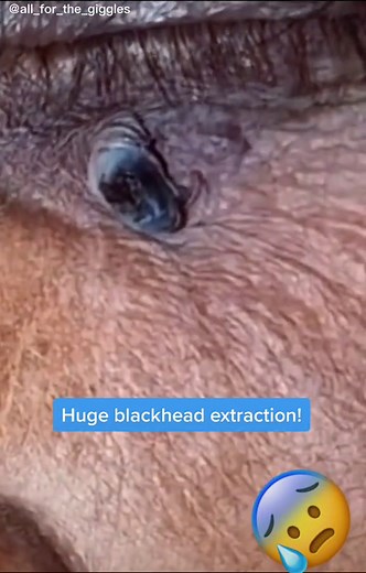 Shicking large blackhead extraction from under eye. #cystpopping #cystexplosion #oddlysatisfying #pimplepopper #blackheadsremoval #cystremoval #zitpopper #skincareviral