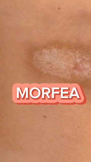 Conoce la Morfea: Esclerodermia Localizada y sus Tratamientos