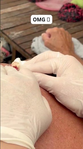 Large Blackheads Extraction Big Cystic Acne Blackheads&Whiteheads Removal Pimple Popping #1021 2026