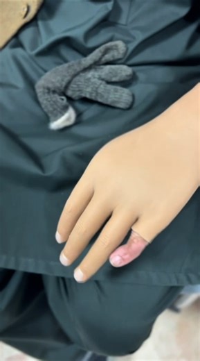 Little Boy Gets Artificial Fingers | Prosthetic Hand Looks 100% Real | Life-Changing Miracle