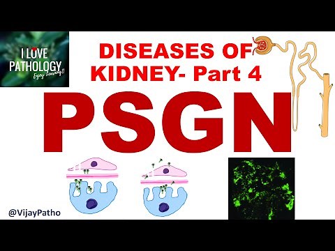 RENAL PATHOLOGY Part 4: Acute Post Streptococcal Glomerulonephritis- Pathogenesis & Morphology