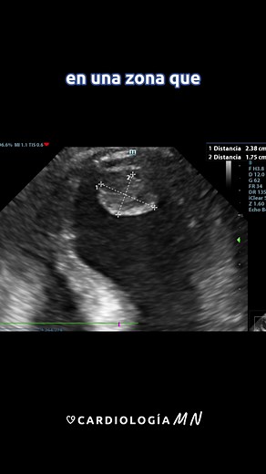 Understanding Blood Clots: Causes, Symptoms, and Treatment Options