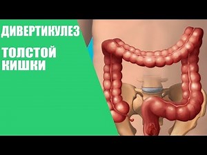 Дивертикулез толстой кишки/Симптомы