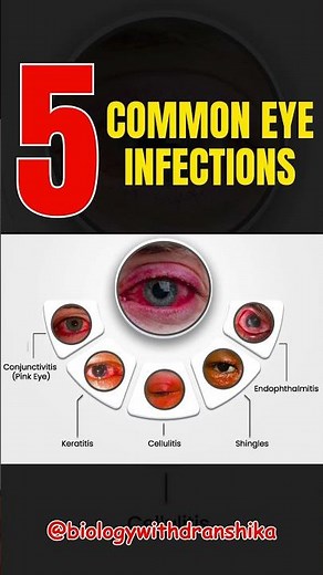 👀 5 Common Eye Infections You Should Know! #eyecare #healthyvision #eyeinfections #conjunctivitis