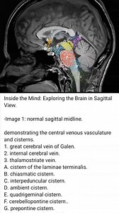 27K views · 155 reactions | #MRI #anatomy #cistern #Brain | CT Scan and MRI study | Facebook