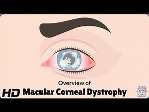 Macular Corneal Dystrophy: How to Recognize and Manage It