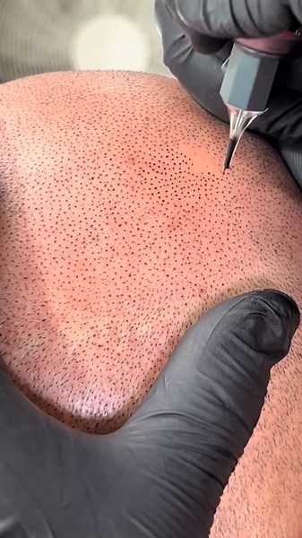 Scalp Micropigmentation for Bald Heads Explained