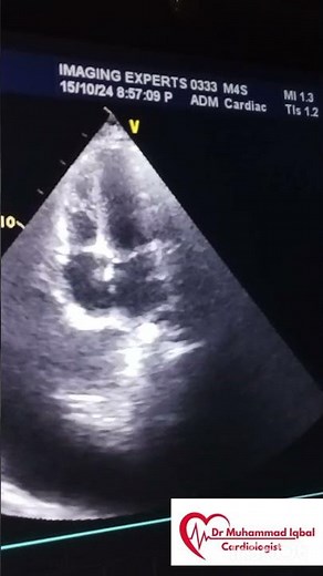 Constrictive pericarditis Echo | CP Echo | Echocardiography toacs | constrictive pericarditis