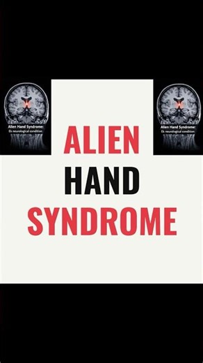 Alien hand syndrome in 30 sec. #medical #mbbs #medicine #symptoms #trending