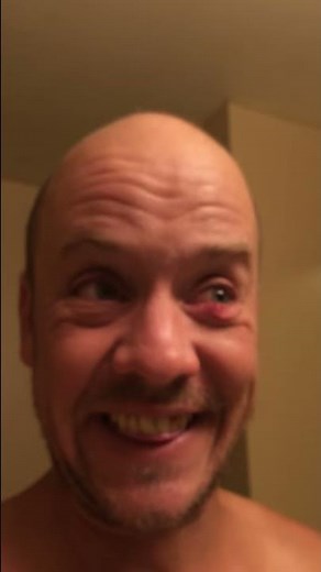 Crazy Nasty eye pimple pop, blood and puss