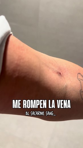 ¿Qué pasa cuando te sacan sangre y aparece un hematoma?