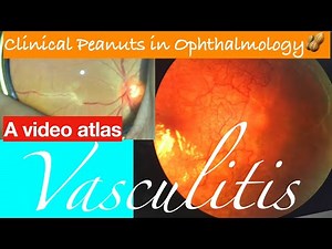 Clinical Peanuts : Retinal Vasculitis 🥜