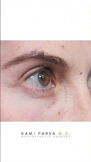 Upper Blepharoplasty for Heavy Upper Eyelids | Before and After Results | Dr. Kami Parsa