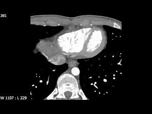 Right Ventricle Anatomy on Axial Cardiac CT