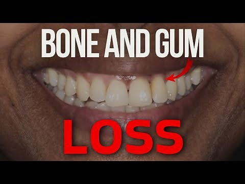 Should I Get a Dental Implant If I Have Bone Loss?
