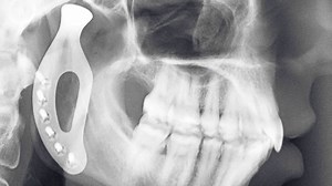 Developing titanium 3D-printed prosthetic jaw | Britannica