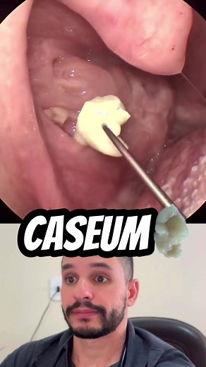 Caseum: O Que São e Como Remover