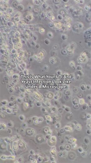 Marilyn | CLS MLS(ASCP) on Instagram: "This is what a UTI AND Yeast Infection Look Like Under A Microscope 👀🥴🤢 The larger circles are the white blood cells. Clearly, there's an infection, so that's why there are hella white blood cells. The smaller circles are the red blood cells. The small dots in the background are bacteria. And the elongated, branchy looking lines are yeast! 🧬DM Me "PASS" To Pass The ASCP Exam🧪🔬"