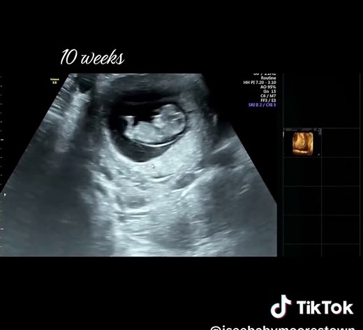Exciting Ultrasound Update at 10 Weeks Pregnant