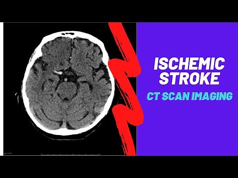 Imaging of Ischemic Stroke/ For Medical students, residents and clinicians