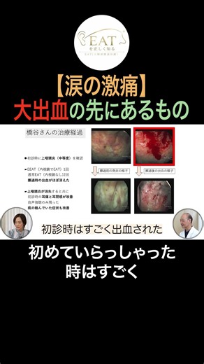 最初は涙が出るほど激痛…治ると「血が一滴も出ない」驚きの治療法 #shorts #耳鼻咽喉科 #上咽頭炎