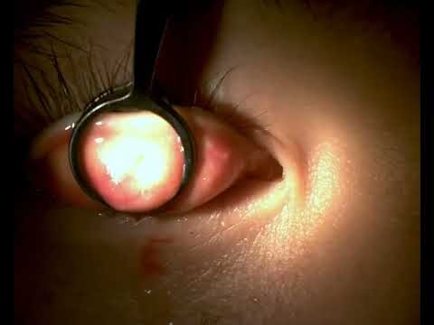 Chalazion + conjunctiva concretion (no edit) i&c