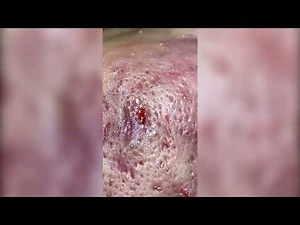 Satisfying Pimple Popping & Cyst Extractions - 146