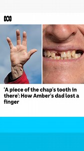 Fingers, who needs them? ✌ In case you missed it, Australian Olympian Matt Dawson lopped his finger off to compete in Paris after a horror scratch match injury last week. After hearing this, ABC Radio Perth listeners called in with their own missing digit stories, and of course, Amber Cunningham had one of her own to add to the collection. | ABC Perth