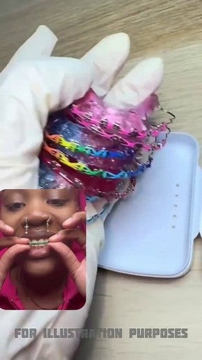 From traditional metal to nearly invisible options, braces come in many forms. See how different approaches are helping people align their teeth today. Learn more. | Tommy Tips